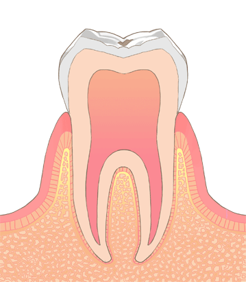 むし歯の治療方法：C0の状態についての画像