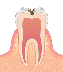 むし歯の治療方法：C2の状態についての画像
