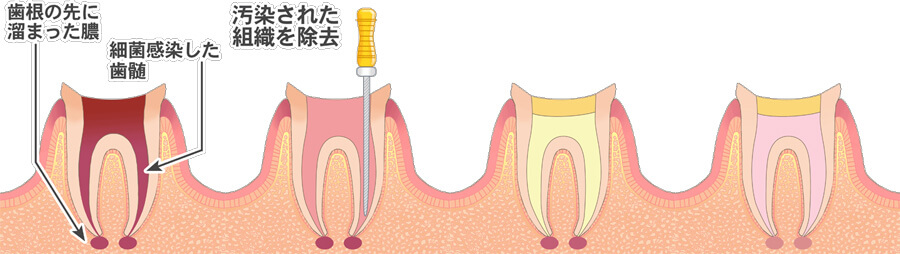 C3のむし歯の治療方法