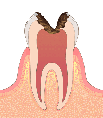 むし歯の治療方法：C3の状態についての画像