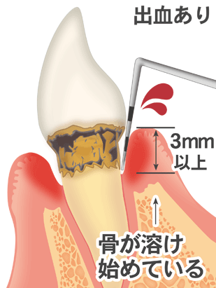 歯周病の進行：中等度歯周炎