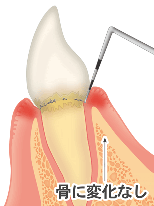 歯周病の治療の流れ
