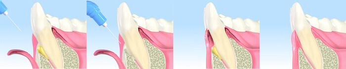 エムドゲイン法（再生療法）