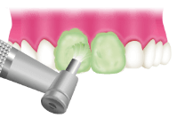 ＰＭＴＣのステップ：①バイオフィルムの除去