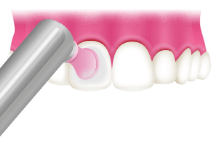 ＰＭＴＣのステップ：②歯の表面を研く
