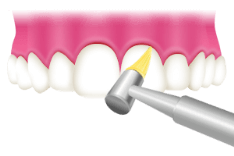 ＰＭＴＣのステップ：②歯の表面を研く