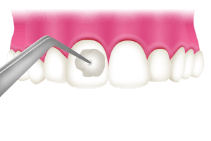 ＰＭＴＣのステップ：③フッ素塗布
